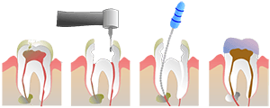 Root Canal by Jeremy Kempe on Wikimedia