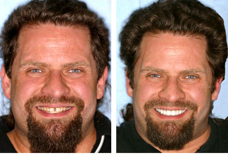 Cosmetic Dentistry closed the gap/diastema between this man's front teeth