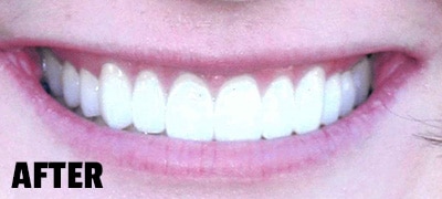 smile showing the after effects of cosmetic dentistry