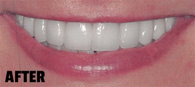 smile showing the after effects of cosmetic dentistry