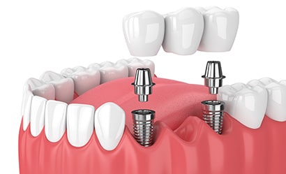 illustration of dental implants showing a dental bridge
