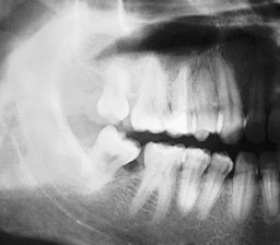Jaw xray by Hominidae on Flickr