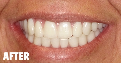 After All-On-X Dental Implants treatment