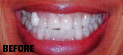patients smile before cosmetic dentistry